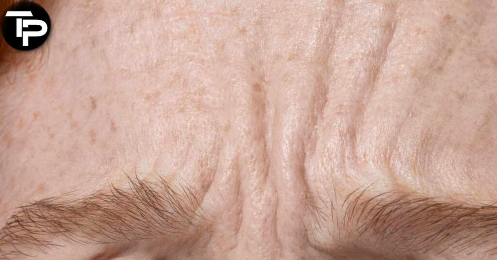 How to Get Rid of Forehead Wrinkles