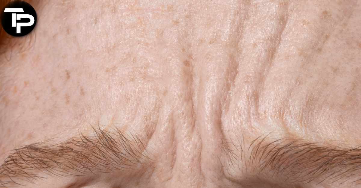 How to Get Rid of Forehead Wrinkles