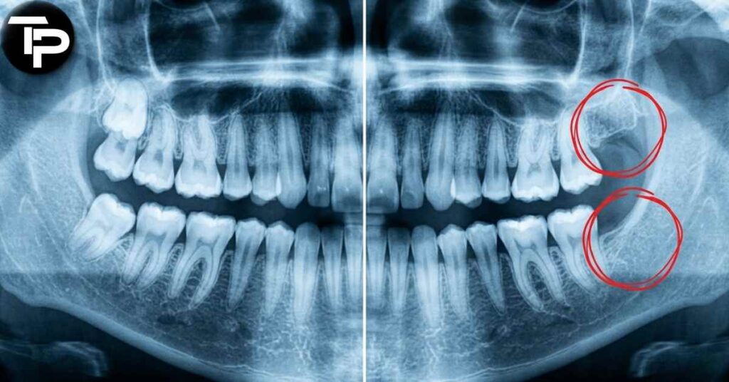 does everyone have wisdom teeth​​