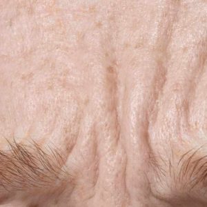 How to Get Rid of Forehead Wrinkles